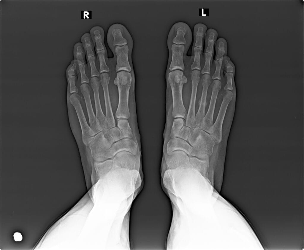 Foot X-ray showing the left foot injury referenced in the Acreimex 21k comeback article.
